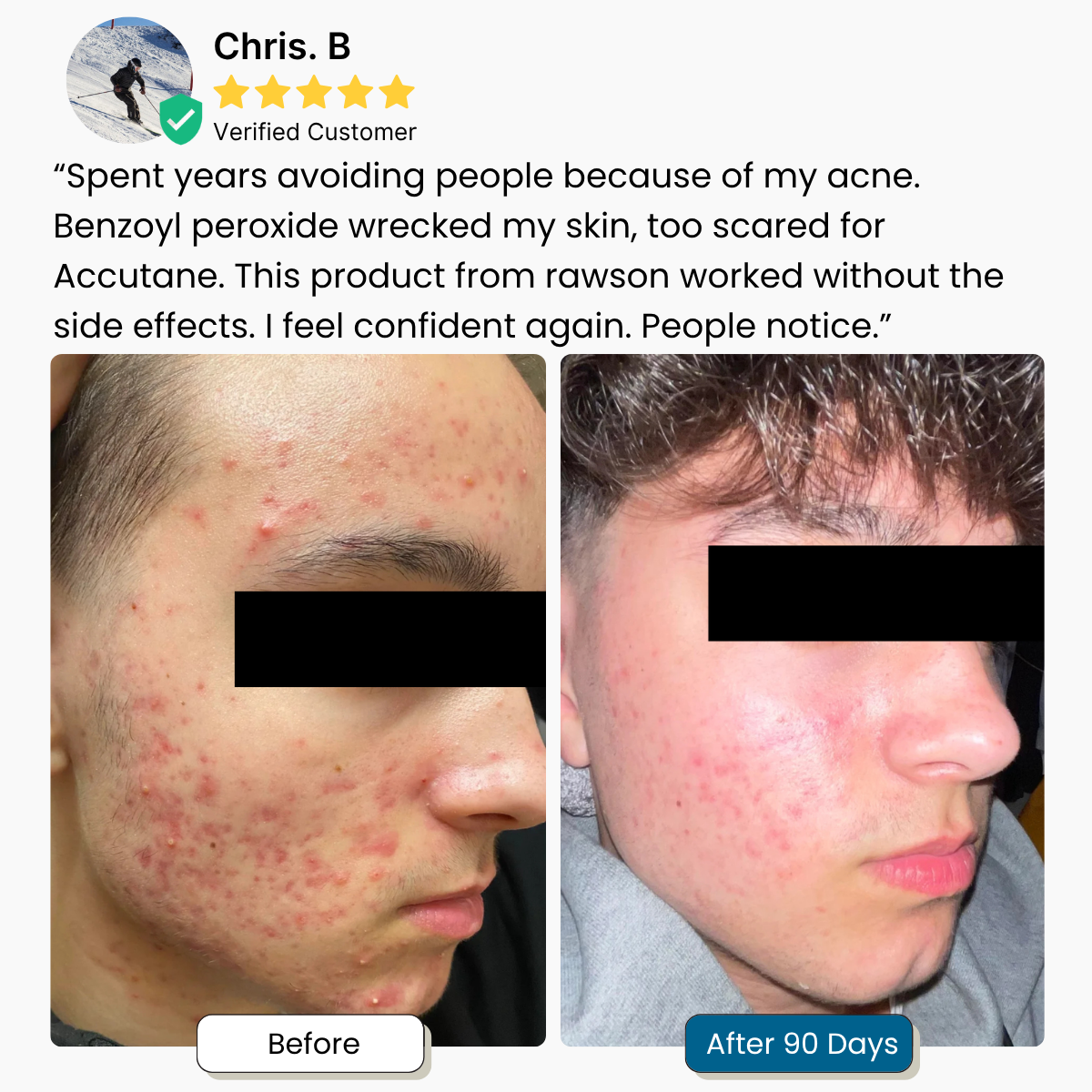 Acne Supplement for Men